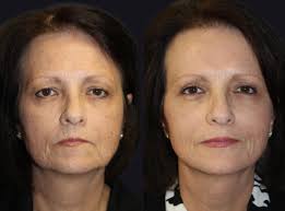 Transform Your Profile with Jawline Fillers in Boston